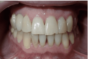 Invisalign 1 2