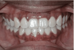 Invisalign 2 2