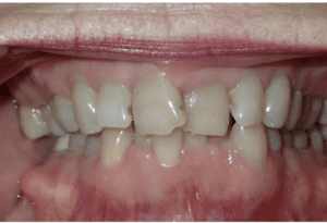 Invisalign 3 1