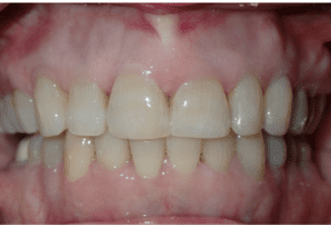 Invisalign 3 2