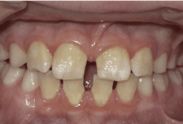 Invisalign 4 1