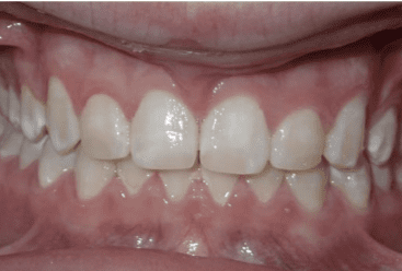 Invisalign 4 2